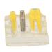 Verdant Touch Dental Implant Model Transparent Dental Implant Model for Dental Teaching Research and Demonstration
