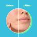 MedVance Advanced Hydrocolloid Acne Patches - Blemish & Zit Patches for Day and Night Use - Buy Online on GoSupps.com