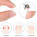 Ingrown Toenail Corrector Strips - 60 Pieces | Toe Nail Correction Brace for Men and Women | Foot Care Solution - 2 Styles Available - Buy Online on GoSupps.com