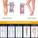 Keephen Medical High Compression Stockings for Varicose Veins - Edema Relief Grade Class II (23-32mmHg) Black Open Toe XL - International Shipping Available - Buy Online on GoSupps.com