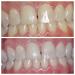 Ultra White 22% Teeth Whitening Gel - Set of 5 tubes (3.8ml each) for Beautiful Smile - Buy Online on GoSupps.com