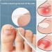 Toenail Corrector Patch Ingrown Nail Corrector Ingrown Nail Treatment Ingrown Nail Corrector Stickers Toenail Correction Toenail Patch - Buy Online on GoSupps.com