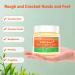 Heat Rash Cream  Eczema  Hand Foot Treat  Tinea Versicolor  Itchy Feet  Butt  Anal Itch  Psoriasis  Scalp Dandruff  Bee Sting  Bites  Boil Cyst  Armpit  Adults Kids  Hidradenitis Suppurativa Treat - Buy Online on GoSupps.com