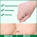 Hydrocolloid Acne Pimple Patch | Invisible Blackhead & Blemish Remover - Buy Online on GoSupps.com