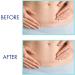 Advanced Silicone Scar Sheets - 4 Reusable Pieces for Keloid, Surgical, Burn, Acne, and C-Section Scars - Buy Online on GoSupps.com