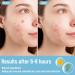 Spot Patches 144 Pieces Invisible Acne Patch Micro Dart Hydrocolloid Pimple Patches Spot Treatment Stickers Spot Stickers for Face and Body Day & Night Skin Care Acne Stickers - Buy Online on GoSupps.com