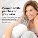 LULLAGE Repigment12 White Patches Corrector Cream - Face and Body Treatment - Buy Online on GoSupps.com