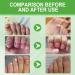 BigyQiu Nail Growth and Repair Serum Keratin 3 Day Growth Nail Treatment & Strengthener Nail Growth Treatment for Nail Strengthener Nail Growth And Repair Fast Keratin Nail Hardener for Damaged Nails - Buy Online on GoSupps.com