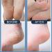  JIAOY Urea cream 60% 60% urea cream for cracked heels and dry skin repairing cream for cracked heels - Moisturizing cream for hands and feet - Skin softening cream - Buy Online on GoSupps.com