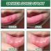 Mouth Ulcer Treatment Spray Mouth Ulcer Spray Mouth Ulcer Treatment for Adults Canker Sore Treatment Herbal Mouth Spray Breath Spray for Bad Breath Canker Relief Spray Mouth Freshener Spray 20ml - Buy Online on GoSupps.com