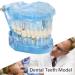Adult Dental Implant Tooth Model - Blue-Transparent Acrylic for Pedagogical Demonstration | Removable Simulation for Dentists - Buy Online on GoSupps.com