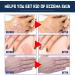 TGMALL 2023 Psoriasis Treatment Spray & Soothing Ointment - Skin Cleansing Relief (3pcs) - Buy Online on GoSupps.com