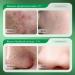 Acne Cream 50g Acne Treatment Gel 3% BHA Spot Cream for Acne Acne Spot Treatment Acne Moisturiser Face Dark Spot Remover for Face Spot Cream for Teenagers Acne Moisturiser Face acne face cream - Buy Online on GoSupps.com