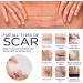 Silicone Scar Sheets - Treating Keloid, C-Section, Tummy Tuck - Surgical Gel Patch Bandage - Transparent Reusable Breathable - Buy Online on GoSupps.com