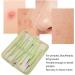 Qukaim Blackhead Remover Needle Set Stainless Steel Pimple Extractor Needles Set Blackheads Remover Tool for Skin Care - Buy Online on GoSupps.com
