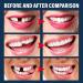 Temporary Tooth Repair Kit with Dental Mirror Tools - Replacement Beads for Missing & Broken Teeth - Buy Online on GoSupps.com