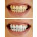 10% Carbamide Peroxide Teeth Whitening Gel - 10 pc Tooth Bleaching Dispensers - Buy Online on GoSupps.com
