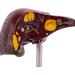 ARAZI Human Liver Pathology Model Visualization of Liver Lesions Clear Details Medical Teaching Props for Doctor-Patient Communication - Buy Online on GoSupps.com