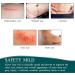 ZORCK Scar Sticker Silicone Tape Roll - 1.5in x 118in - Effective Scar Removal for Caesarean Section, Keloid, Burns & Acne - Buy Online on GoSupps.com