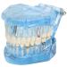 Tooth model standard model adult pathologies dental implant dentist blue-transparent acrylic tooth model for pedagogical demonstration tooth model removable simulation