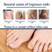 100PCS Ingrown Toe Nail Correction Sticker - Health Toenail Corrector Patch - Buy Online on GoSupps.com