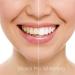 Teeth Whitening Gel 10ml Syringe 44% Carbamide Peroxide - 4 Pack - Buy Online on GoSupps.com