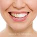 Teeth Whitening Gel 35% Carbamide Peroxide Professional Dispenser - 3 Pack (30ml each) - Buy Online on GoSupps.com