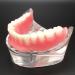 Dental Teeth Model - Lower Removable Overdenture with 2 Implants | Dentist Assistant Supplies - International Shipping - Buy Online on GoSupps.com