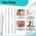 5PC Blackhead & Pimple Removal Kit with Tweezers - Facial Spot Popping Tool Set - Buy Online on GoSupps.com