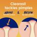 Clearasil Stubborn Acne Control 5-in-1 Spot Treatment Cream | Benzoyl Peroxide Acne Medication | 1oz (Pack of 3) - Buy Online on GoSupps.com
