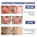 Acne & Spots Cleansing Lotion Relief 50ml | Facial Cleanser for Dry Skin - Reduce Dullness - Buy Online on GoSupps.com