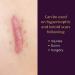 Mederma Medical Grade Silicone Scar Sheet 1.4x3 inches (4 Count) - For Injury, Burn, and Surgery Scars - Buy Online on GoSupps.com