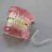 HDGRNCC Dental Orthodontic Brackets Model - Metal Ceramic Self-Ceramic Bracket for Training | International Shipping - Buy Online on GoSupps.com