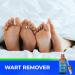 Liquid Wart Remover | Fast-Acting Advanced Treatment for All Wart Types - Painless Solution for Common & Genital Warts - International Shipping Available - Buy Online on GoSupps.com