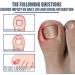 Ingrown Toenail Treatment Oil - Anti Paronychia Relief & Nail Growth Formula - Buy Online on GoSupps.com