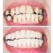Jiazhou Hub Temporary Prostheses: 2 Pairs Cosmetic Veneers & Snap-On Dentures for a Natural Smile - Buy Online on GoSupps.com