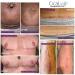 CicaLux Silicone Scar Tape - Triple Action Treatment for Surgical Scars - 60 Day Supply - Buy Online on GoSupps.com