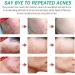 Anti Acne Face Cream Dark Spot Remover for Face Spot Cream for Acne Treatment and Spot Treatment Age Spot Remover for Face Rapid Action Spot Cream for Blackheads and Acne Prone Skin - Buy Online on GoSupps.com
