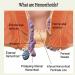 Heca Natural Herbal Hemorrhoid Capsules 2023 - Natural Relief for Hemorrhoids - 2pcs - Buy Online on GoSupps.com