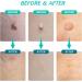 2 in 1 Skin Tag Remover Pen for Small to Large Skin Tags - Painless Wart Removal Device - Easy Tag Removal Kit - Green - Buy Online on GoSupps.com