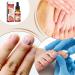 Nail and Toenail Strengthening Liquid - 10ml Ingrown Toenail Corrector Drops - Beauty Care for Hands and Feet - Night Travel Treatment for Dry Damaged Cracked Curved Fragile and Chipped Nails - Buy Online on GoSupps.com