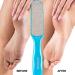 Probelle Double Sided Multidirectional Nickel Foot File - Instant Callus & Corn Remover Tool (Blue) Safe & Effective Foot Care - Buy Online on GoSupps.com