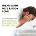 Maximum-Strength 10% Benzoyl Peroxide Acne Wash for Face, Skin, Butt, Back & Body - 8 oz - Vegan & Cruelty-Free - Buy Online on GoSupps.com