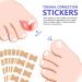 Ingrown Toenail Treatment - Painless Corrector Strips & Nail Correction Patches | 100 Pcs - Buy Online on GoSupps.com