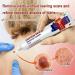 2023 Herpes Remover & Wart Ointment - Genital & Vulva Treatment (20g 2 PCS) - Effective Condyloma Acuminatum Relief - Fast International Shipping - Buy Online on GoSupps.com