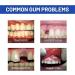 Furzero Oral Gel for Gum Treatment | Effective Gum Therapy & Protection (1PC) - Buy Online on GoSupps.com