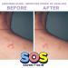 SOS SAVER OF SKIN - Hydrocolloid Acne Patches for Body Back Chest & More | 10 Count | Vegan & Latex Free - Buy Online on GoSupps.com