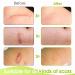 Silicone Scar Sheets 1.6 x 60 Roll - Effective Silicone Gel Tape for Scar Removal - C-Section, Keloid, Burn & Acne - 1.5M Roll - Buy Online on GoSupps.com