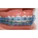 Element Comfort Cover Braces Guard - Snap On Mouth Protector for Braces (Blue) - Buy Online on GoSupps.com