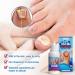 Fungal Nail Treatment - Fungal Nail Treatment for Toenails Extra Strong - Anti Fungus Nail Repair and Strengthen - Toenail Fungus Treatment for Thickening Yellow-Brown Discoloration Ragginess 20ML - Buy Online on GoSupps.com